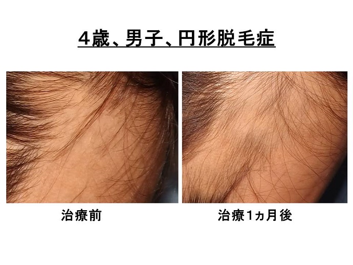 円形脱毛症　病院""